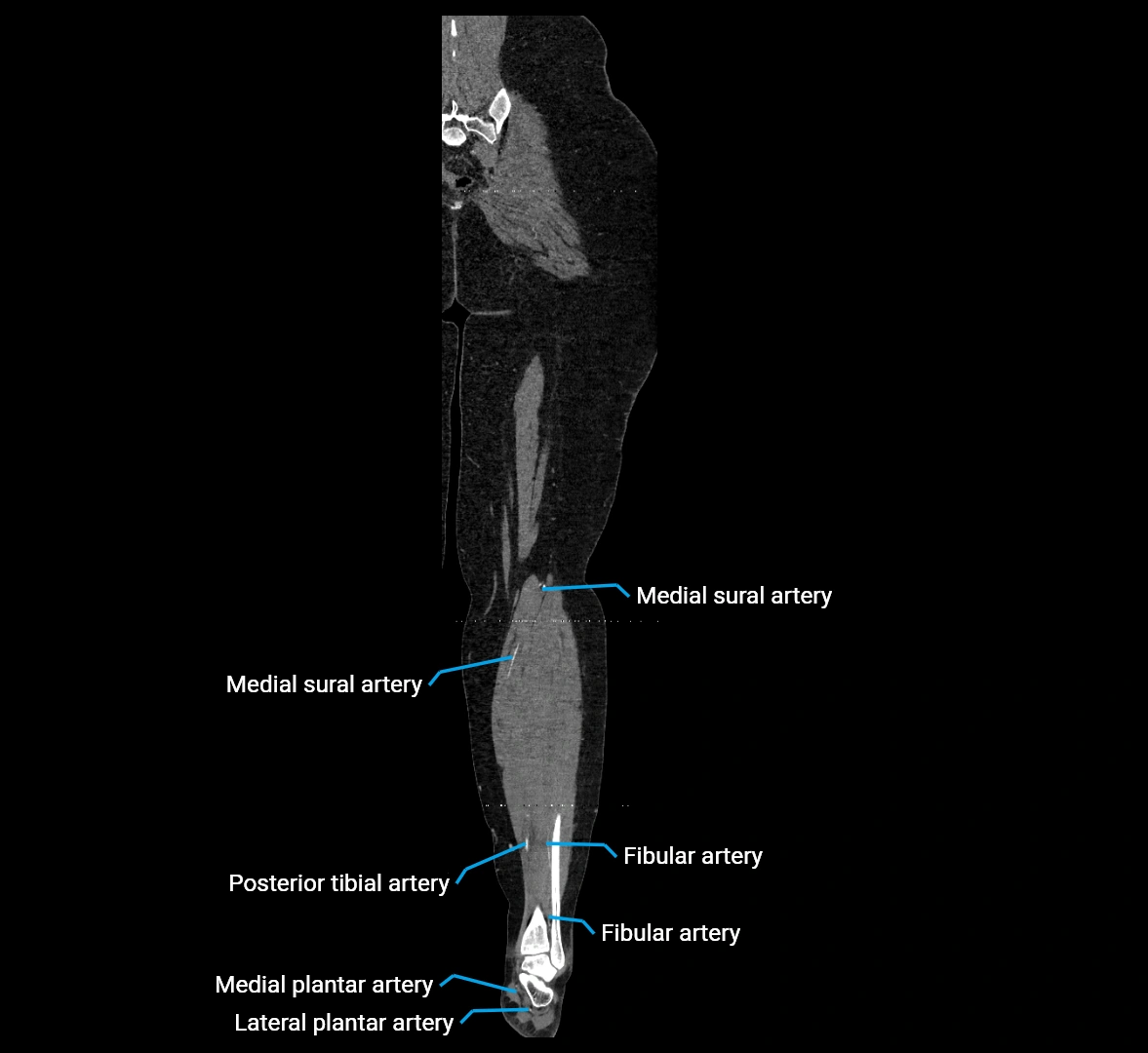 CTA lower limb coronal cross sectional anatomy labelled image _72 (2).webp